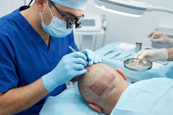 a doctor performing graft extraction via micro-incisions
