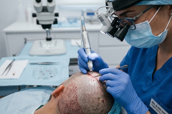 A specialist performs a hair graft extraction using the FUE technique